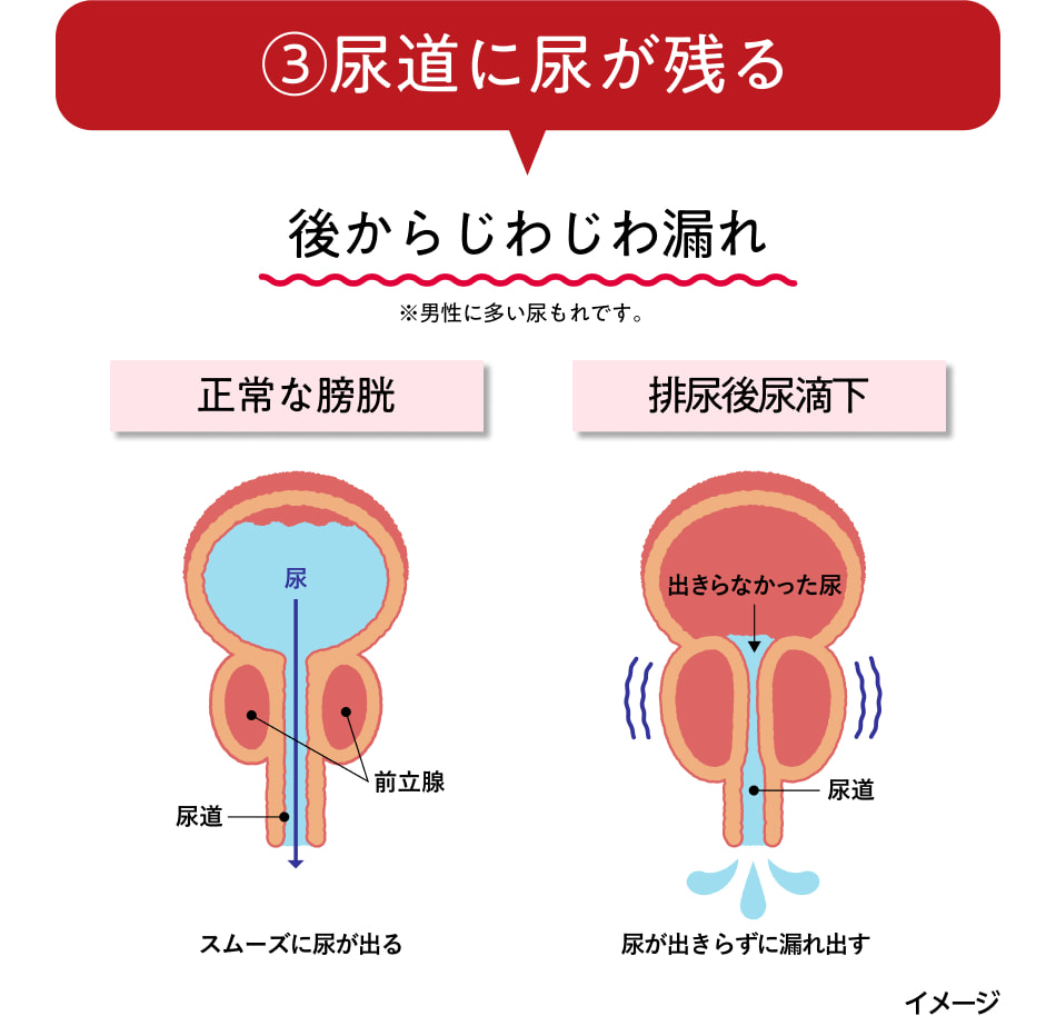 ➂尿道に尿が残る 後からじわじわ漏れ ※男性に多い尿漏れです。 正常な膀胱 スムーズに尿が出る 排尿後尿滴下 尿が出きらずに漏れ出す イメージ